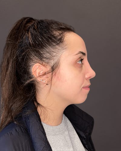 Rhinoplasty Before & After Gallery - Patient 151510785 - Image 2