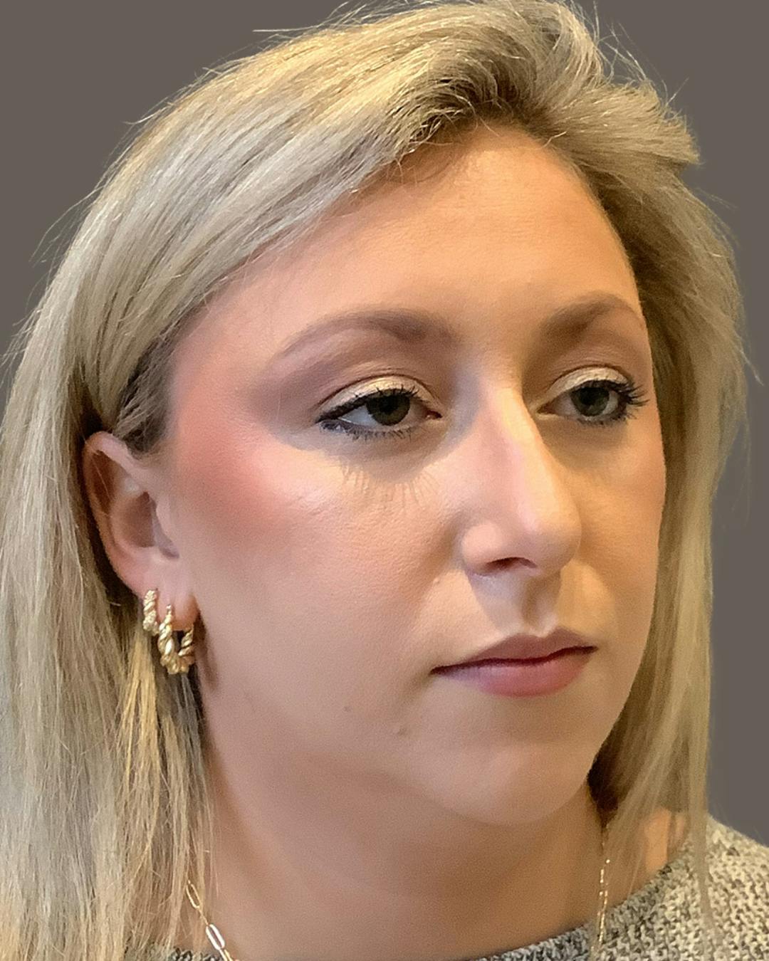 Rhinoplasty Before & After Gallery - Patient 309005 - Image 3