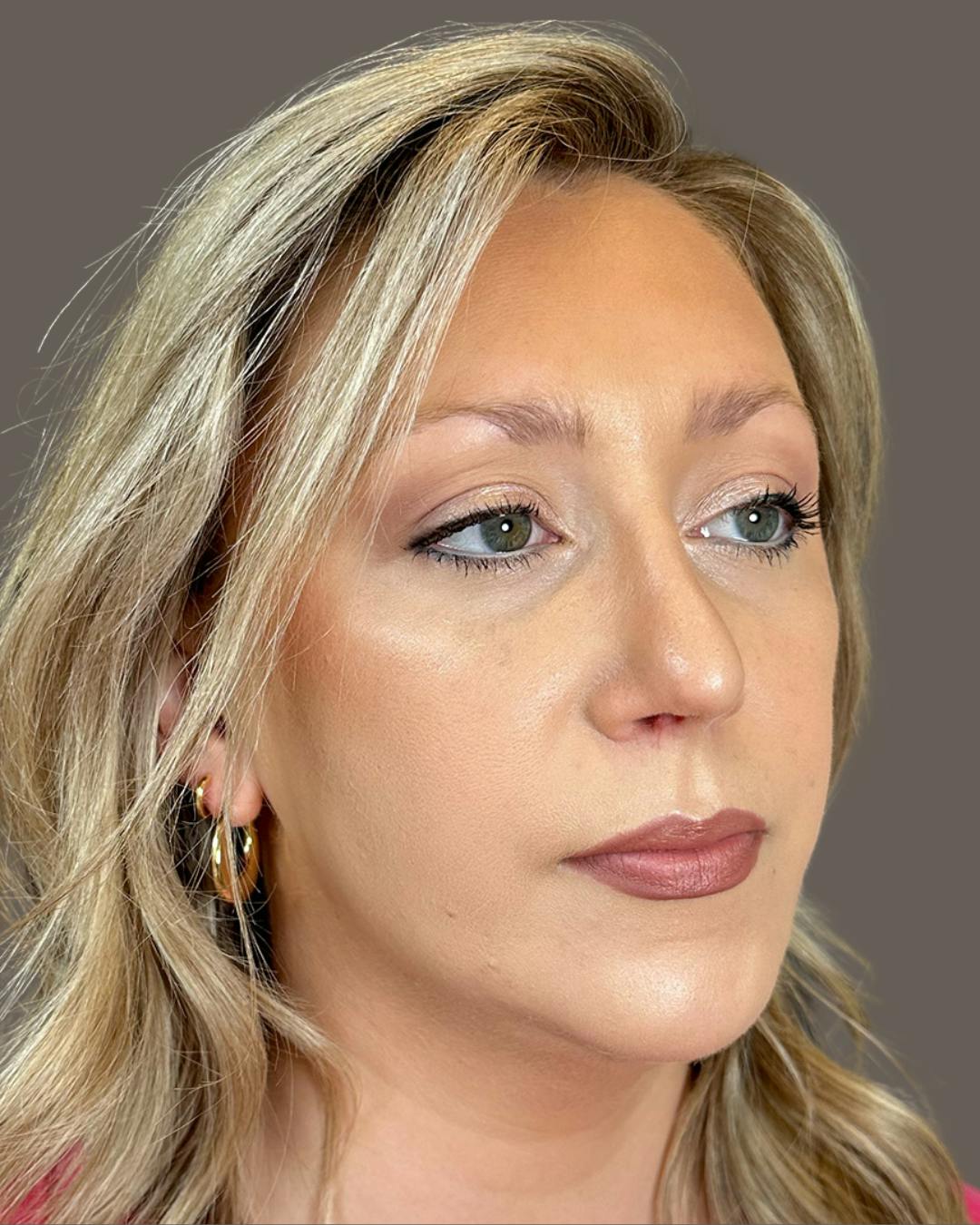 Rhinoplasty Before & After Gallery - Patient 309005 - Image 4