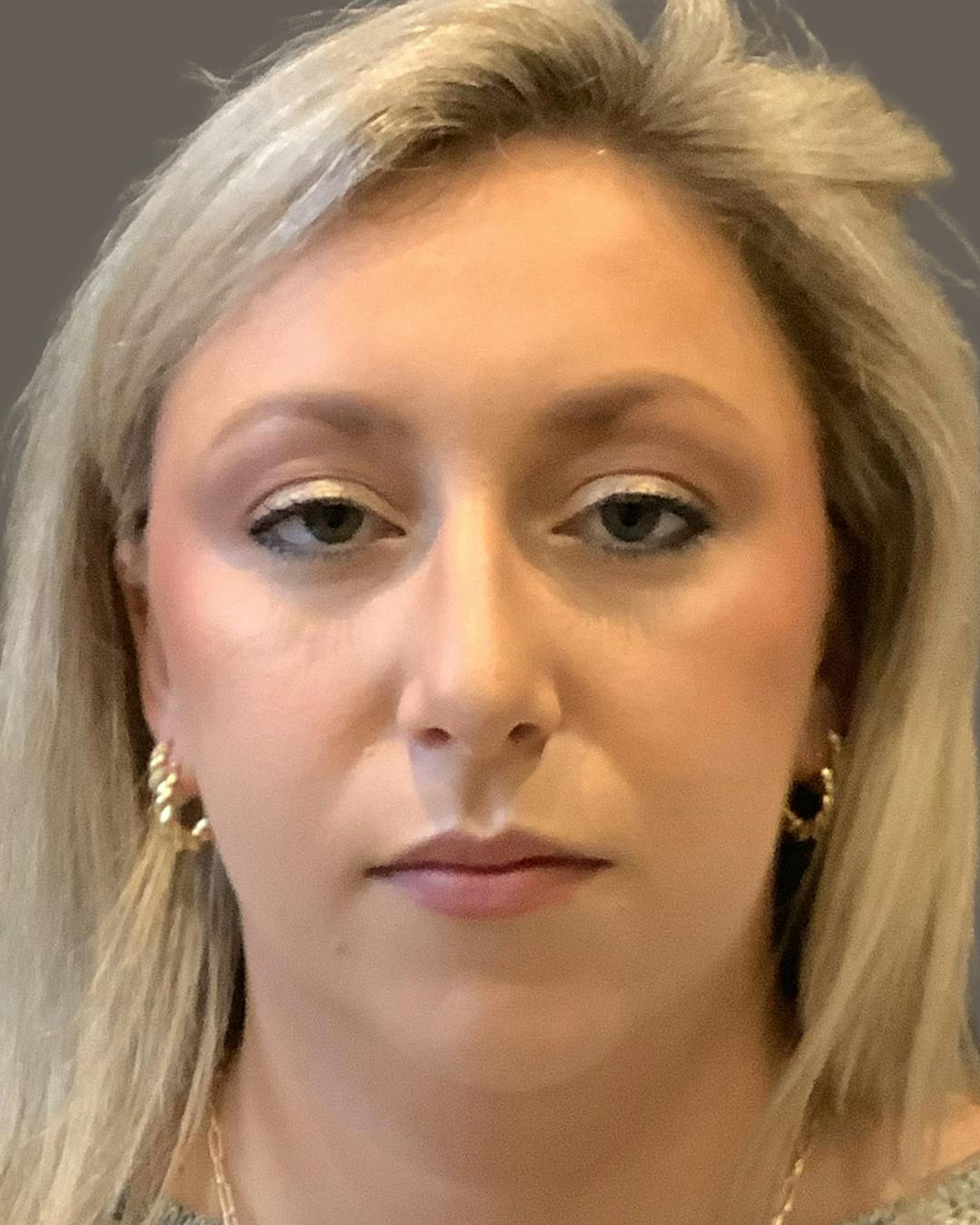 Rhinoplasty Before & After Gallery - Patient 309005 - Image 5