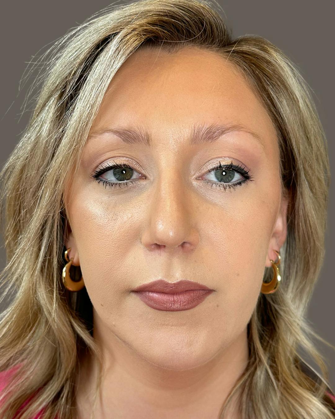 Rhinoplasty Before & After Gallery - Patient 309005 - Image 6