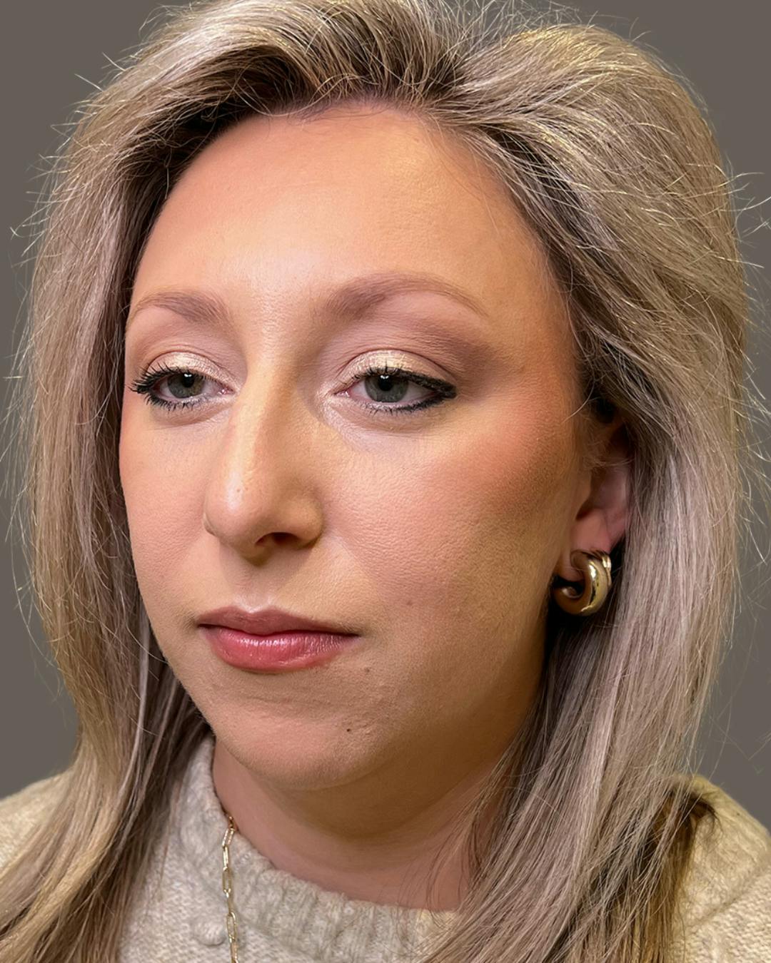 Rhinoplasty Before & After Gallery - Patient 309005 - Image 7