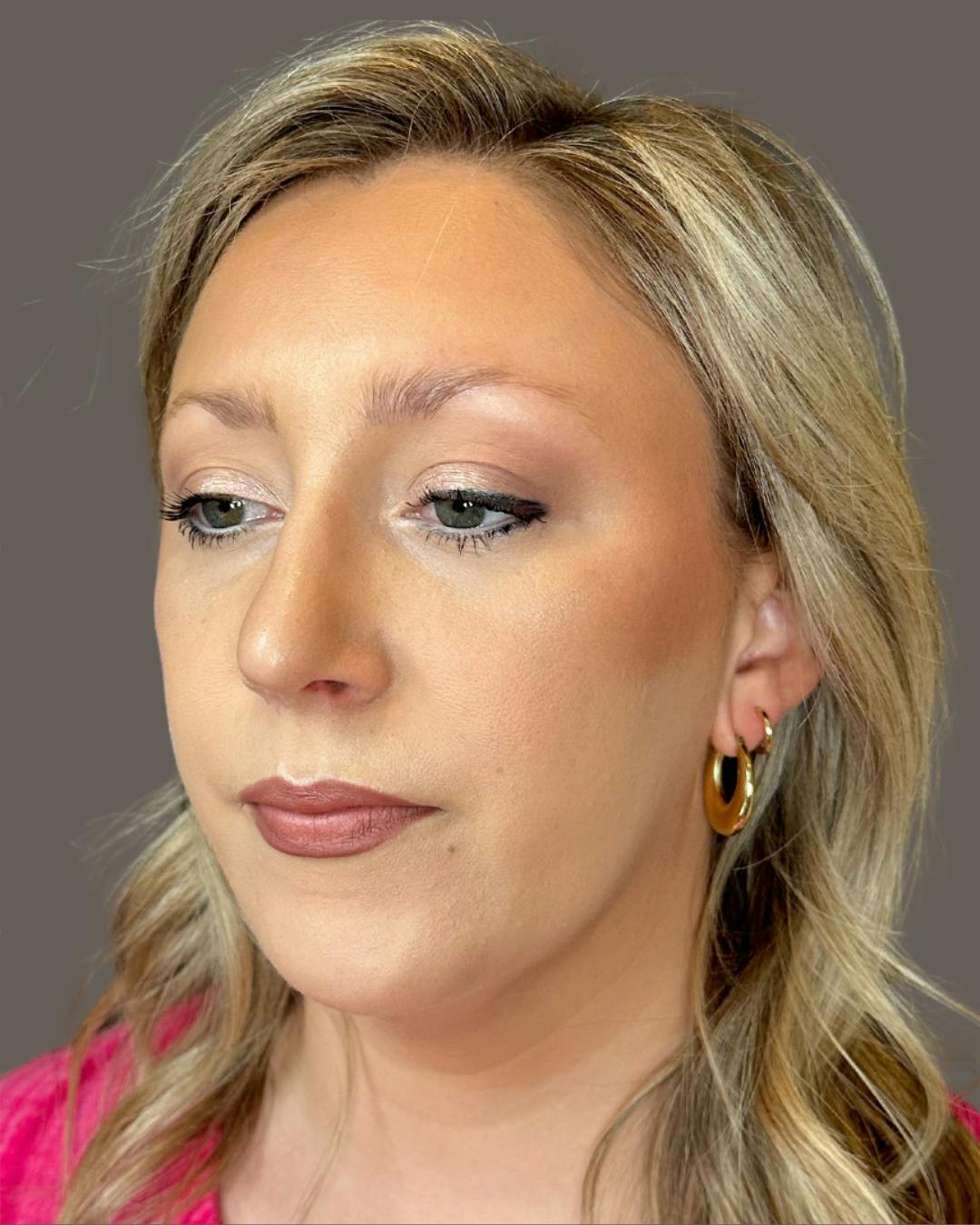 Rhinoplasty Before & After Gallery - Patient 309005 - Image 8