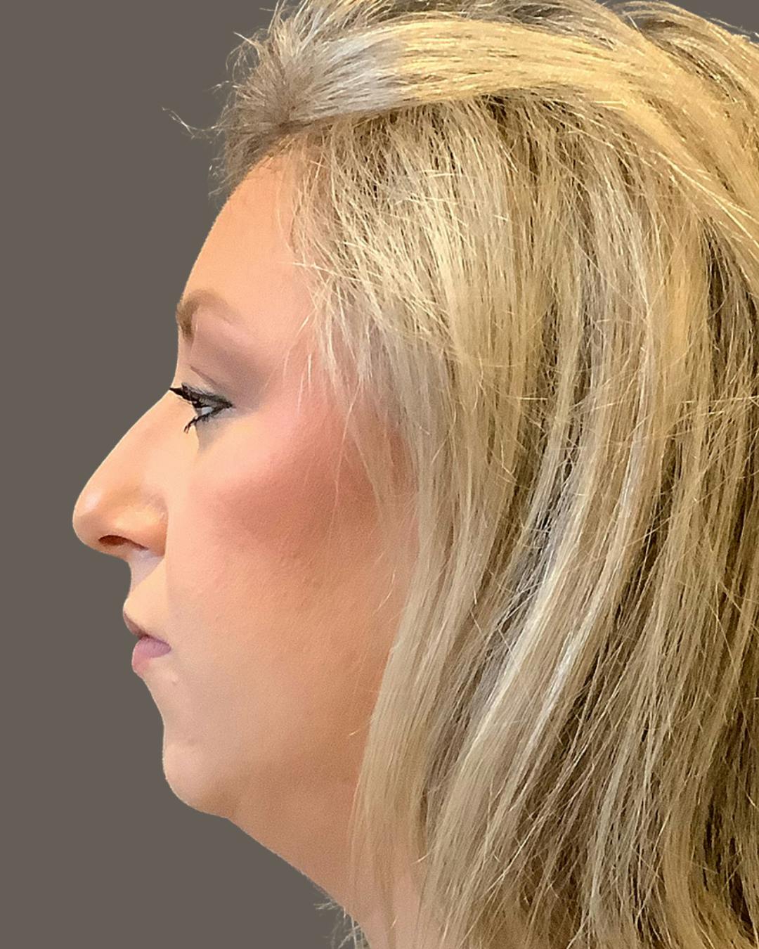 Rhinoplasty Before & After Gallery - Patient 309005 - Image 9