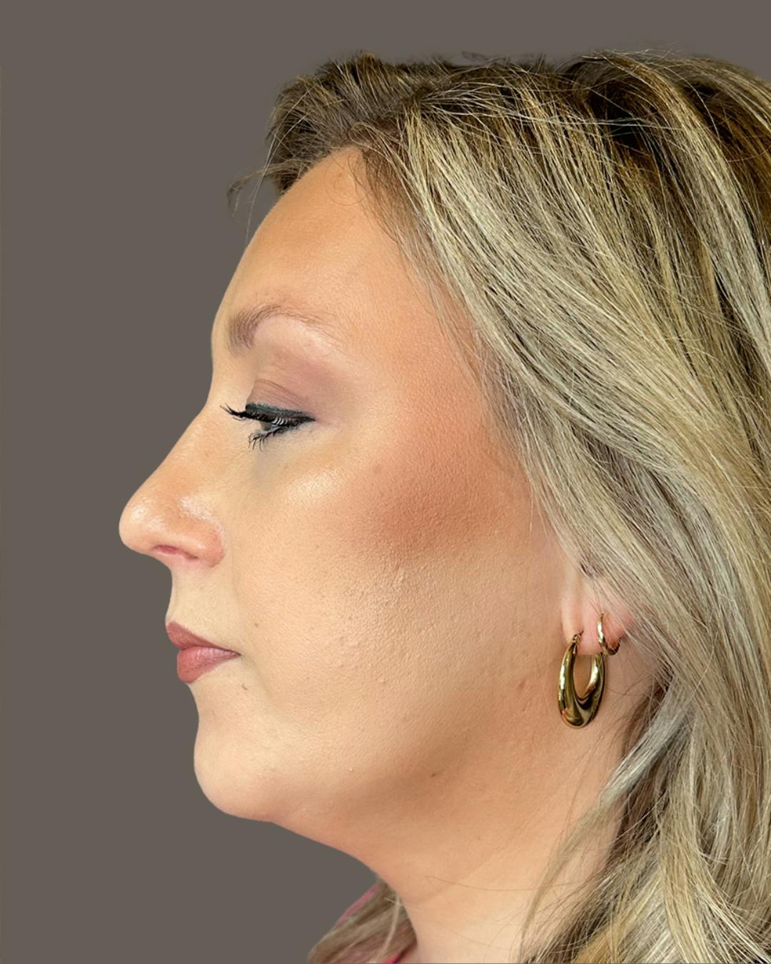 Rhinoplasty Before & After Gallery - Patient 309005 - Image 10