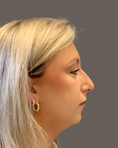 Rhinoplasty Before & After Gallery - Patient 309005 - Image 1
