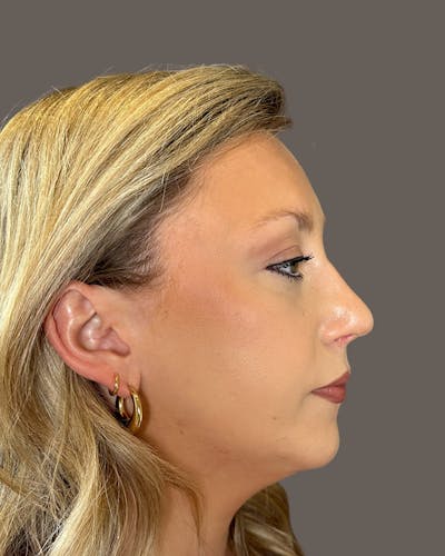 Rhinoplasty Before & After Gallery - Patient 309005 - Image 2