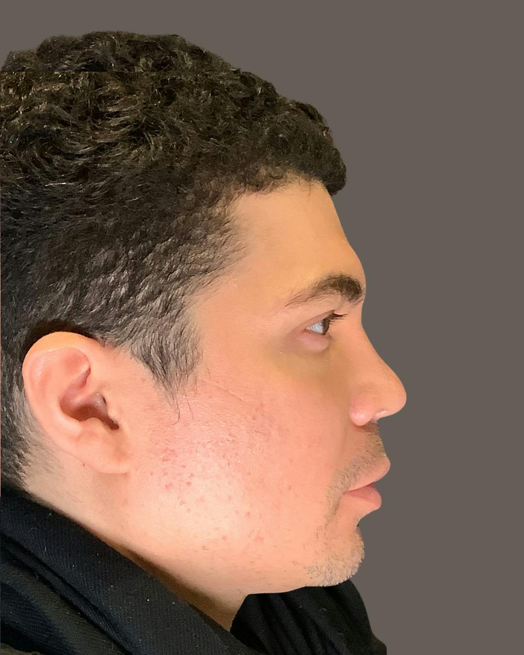 Rhinoplasty Before & After Gallery - Patient 169027 - Image 2