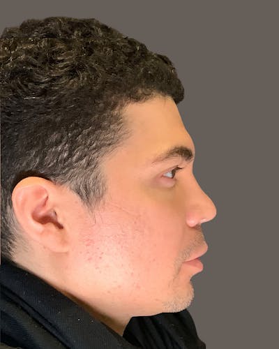 Rhinoplasty Before & After Gallery - Patient 169027 - Image 2
