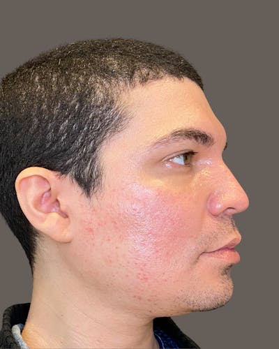 Rhinoplasty Before & After Gallery - Patient 169027 - Image 1