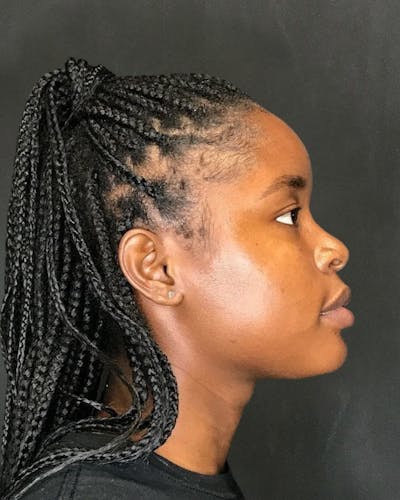 Rhinoplasty Before & After Gallery - Patient 151510787 - Image 1