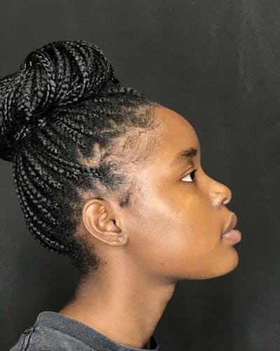 Rhinoplasty Before & After Gallery - Patient 151510787 - Image 2