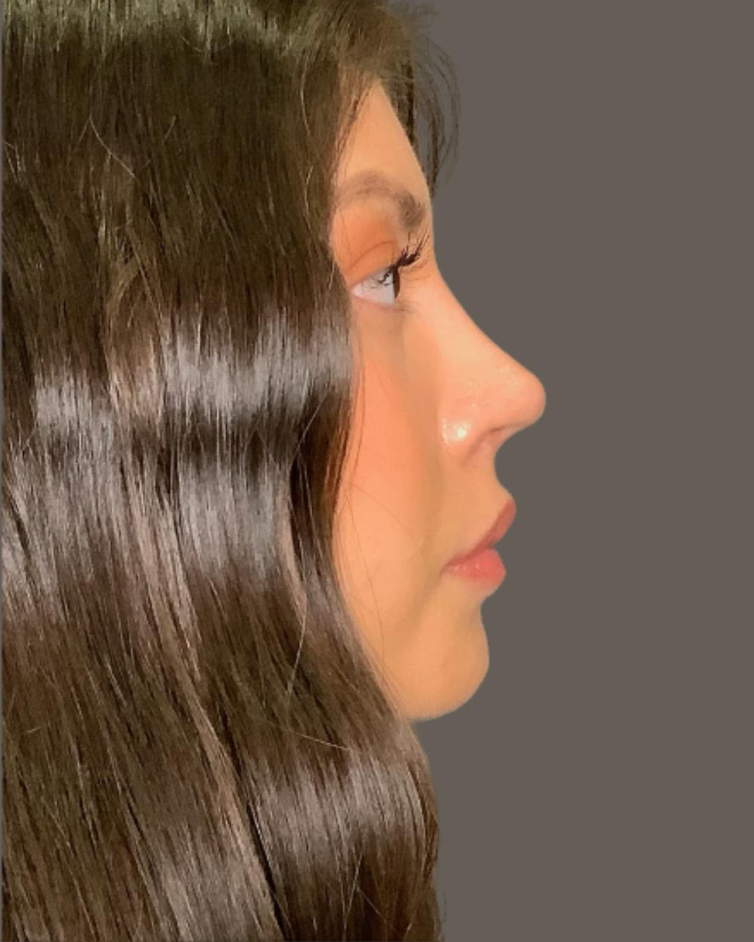 Rhinoplasty Before & After Gallery - Patient 127898 - Image 2
