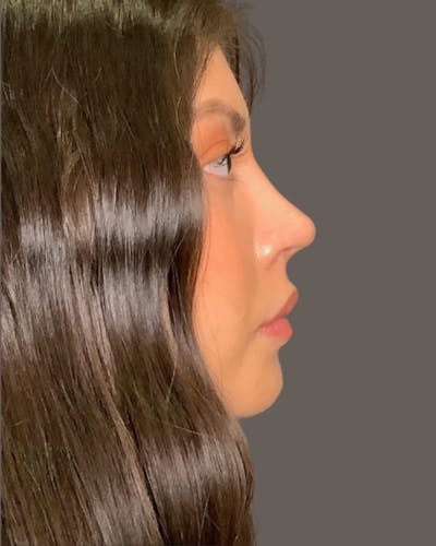 Rhinoplasty Before & After Gallery - Patient 127898 - Image 2