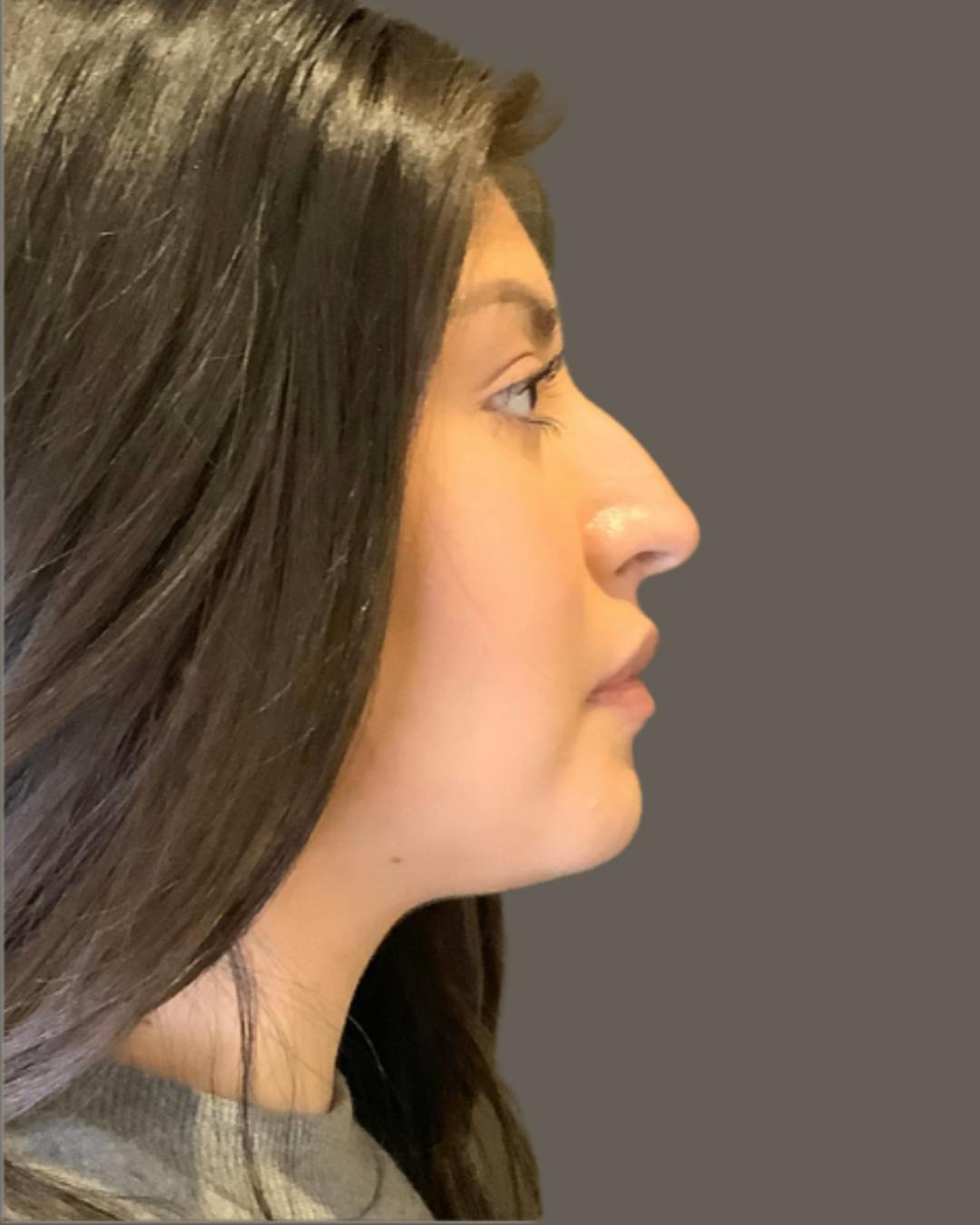 Rhinoplasty Before & After Gallery - Patient 127898 - Image 1