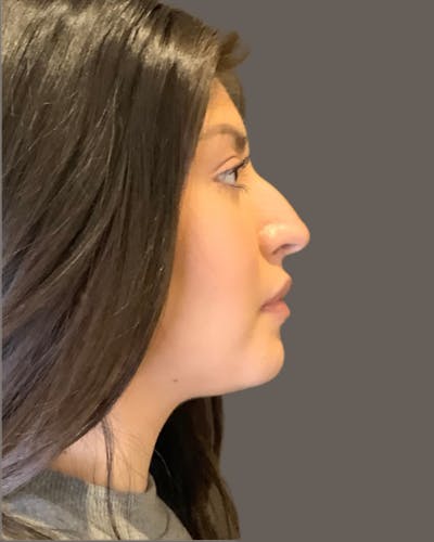 Rhinoplasty Before & After Gallery - Patient 127898 - Image 1