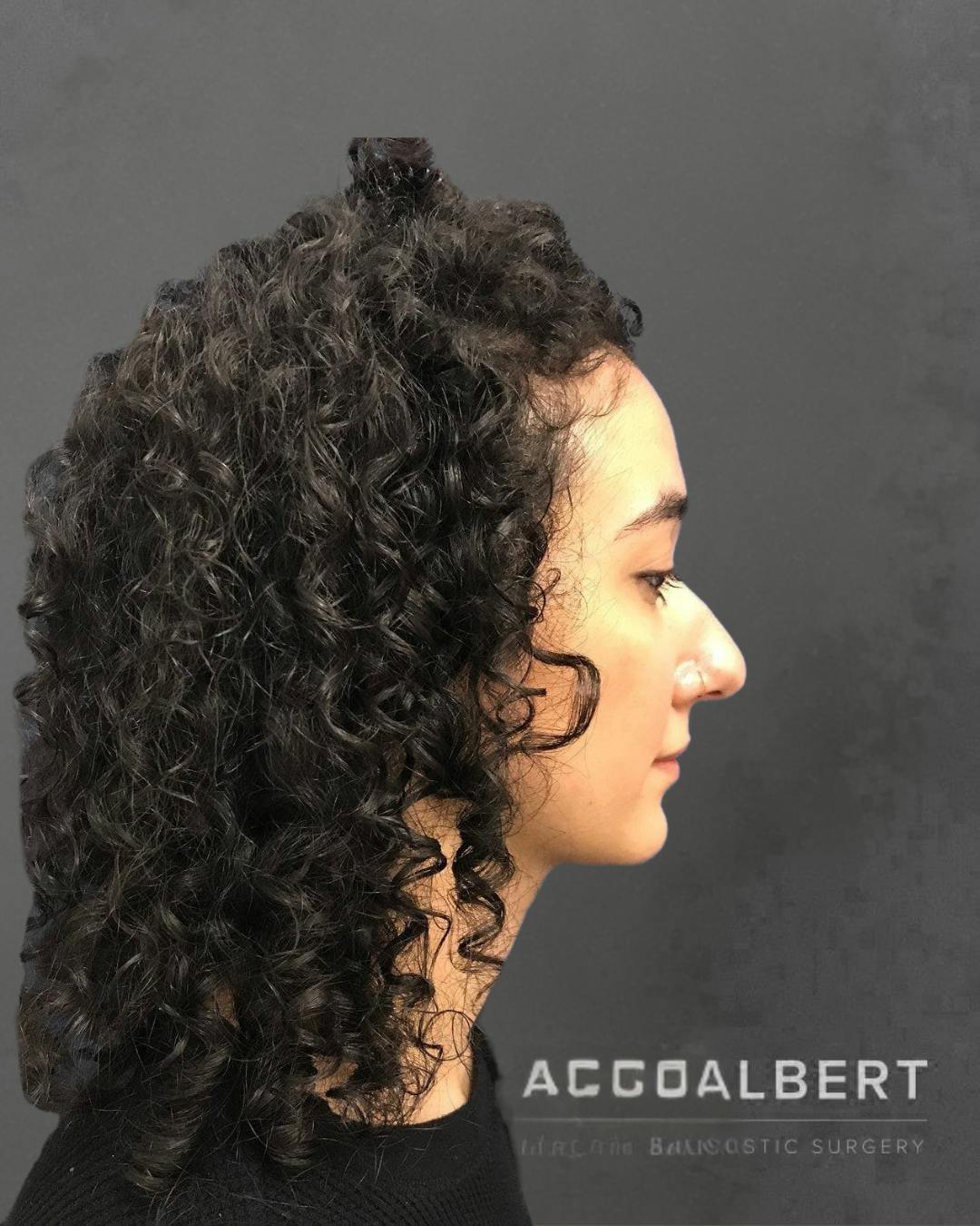 Rhinoplasty Before & After Gallery - Patient 151510786 - Image 1