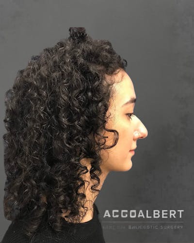 Rhinoplasty Before & After Gallery - Patient 151510786 - Image 1