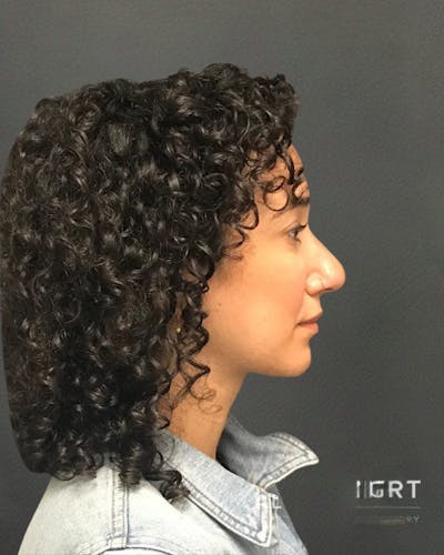 Rhinoplasty Before & After Gallery - Patient 151510786 - Image 2