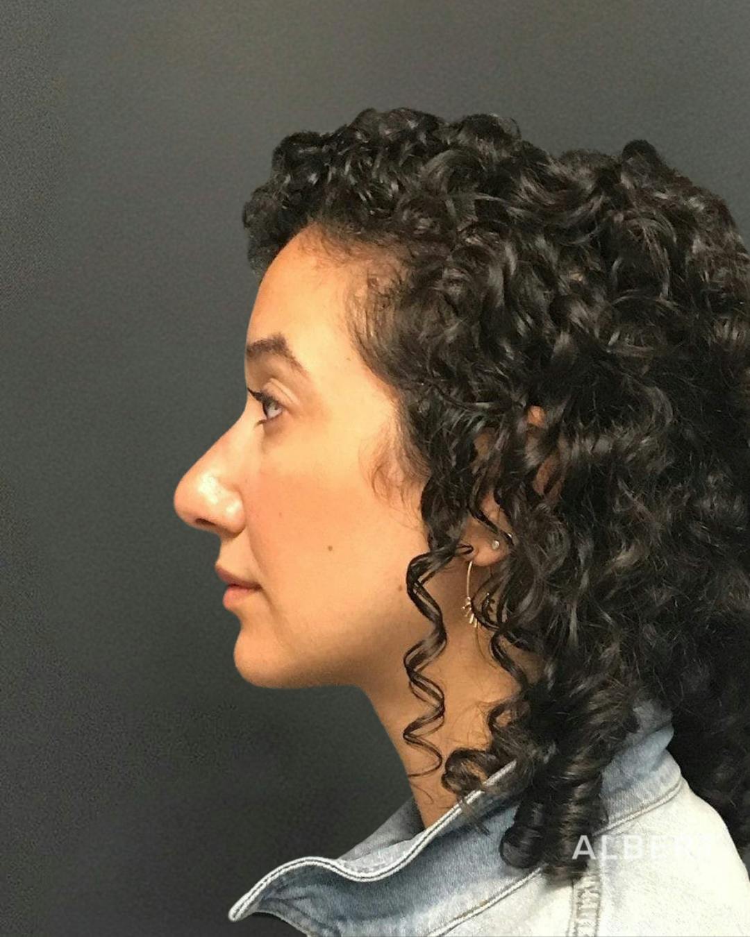 Rhinoplasty Before & After Gallery - Patient 151510786 - Image 10