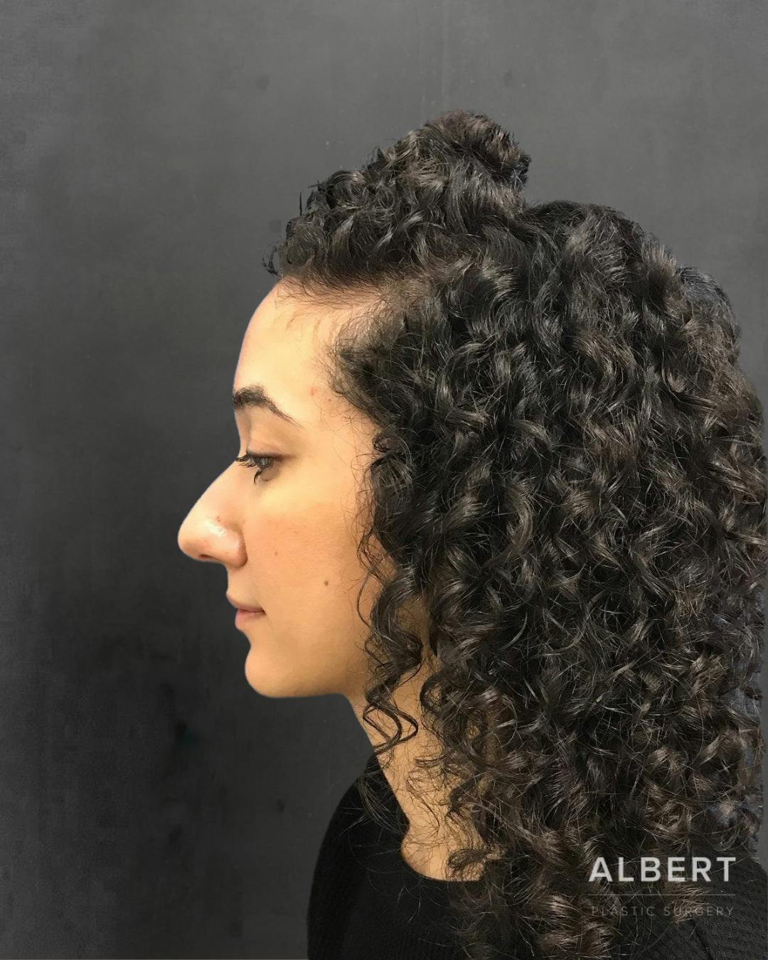 Rhinoplasty Before & After Gallery - Patient 151510786 - Image 9