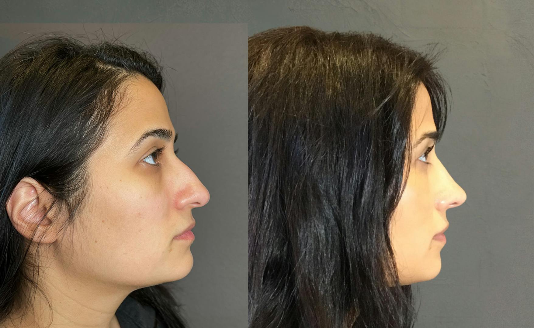 Rhinoplasty Before & After Gallery - Patient 329170 - Image 1