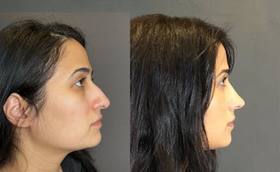 Rhinoplasty Before & After Gallery - Patient 329170 - Image 1