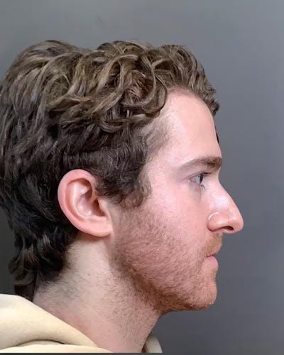 Rhinoplasty Before & After Gallery - Patient 422489 - Image 1