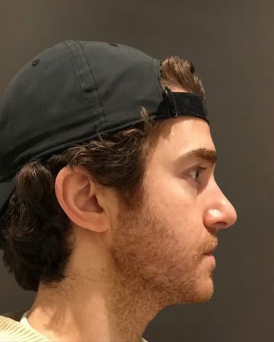 Rhinoplasty Before & After Gallery - Patient 422489 - Image 2