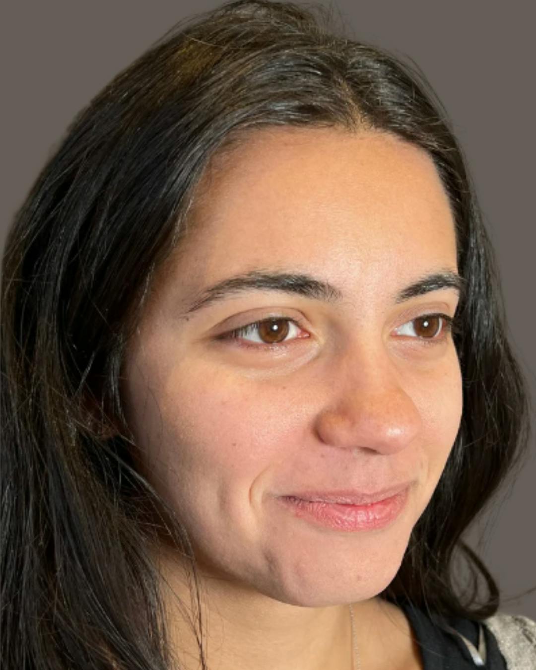 Rhinoplasty Before & After Gallery - Patient 171247 - Image 7