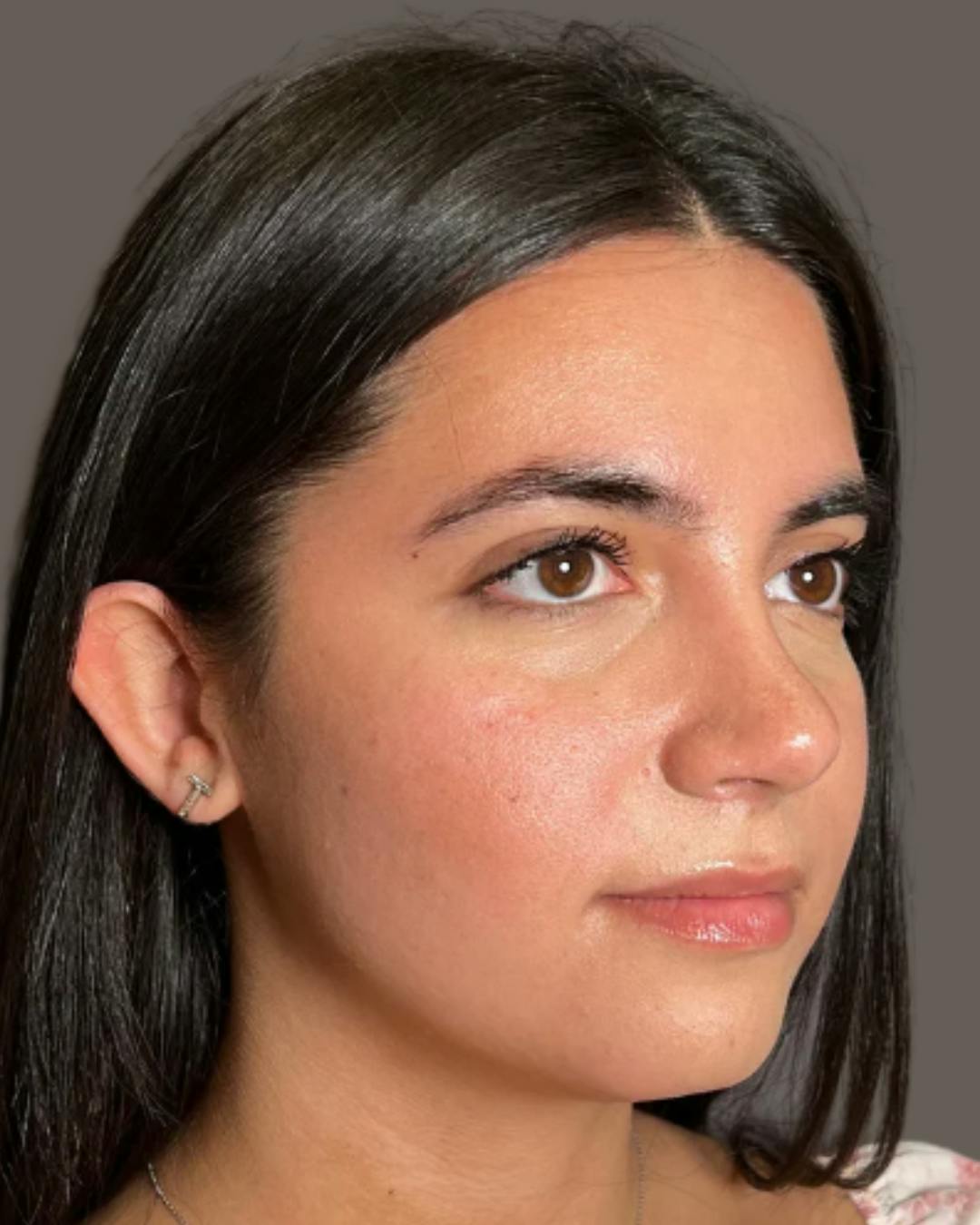 Rhinoplasty Before & After Gallery - Patient 171247 - Image 8