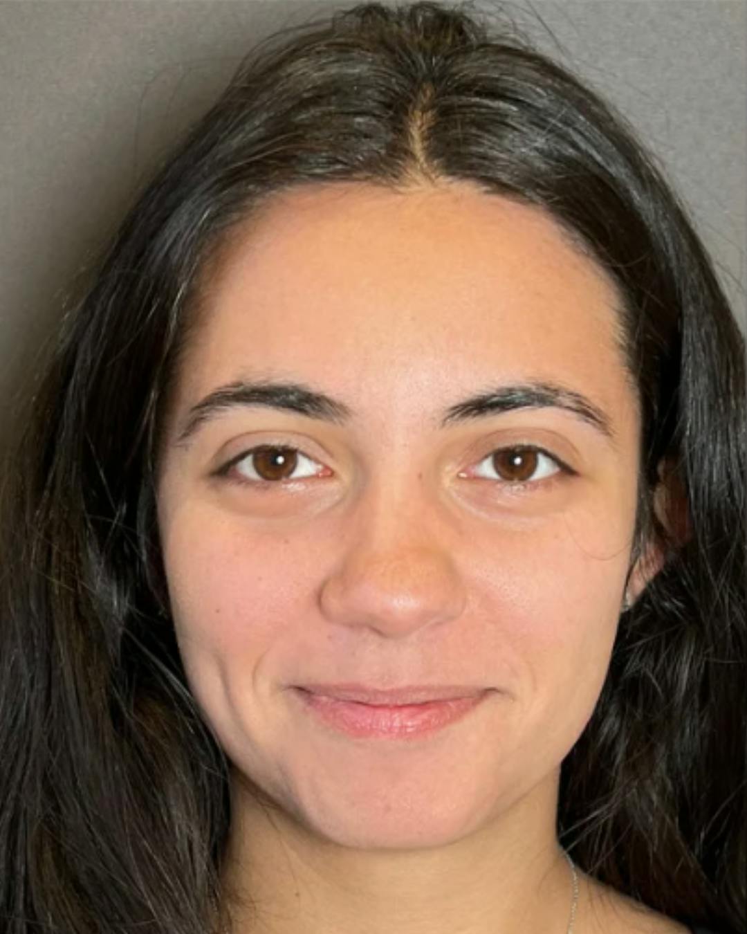 Rhinoplasty Before & After Gallery - Patient 171247 - Image 3