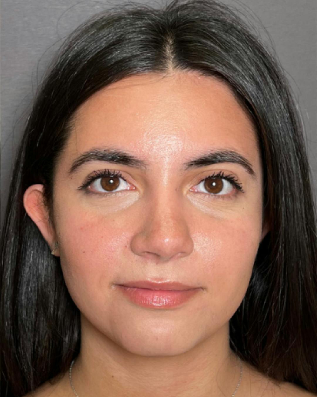 Rhinoplasty Before & After Gallery - Patient 171247 - Image 4