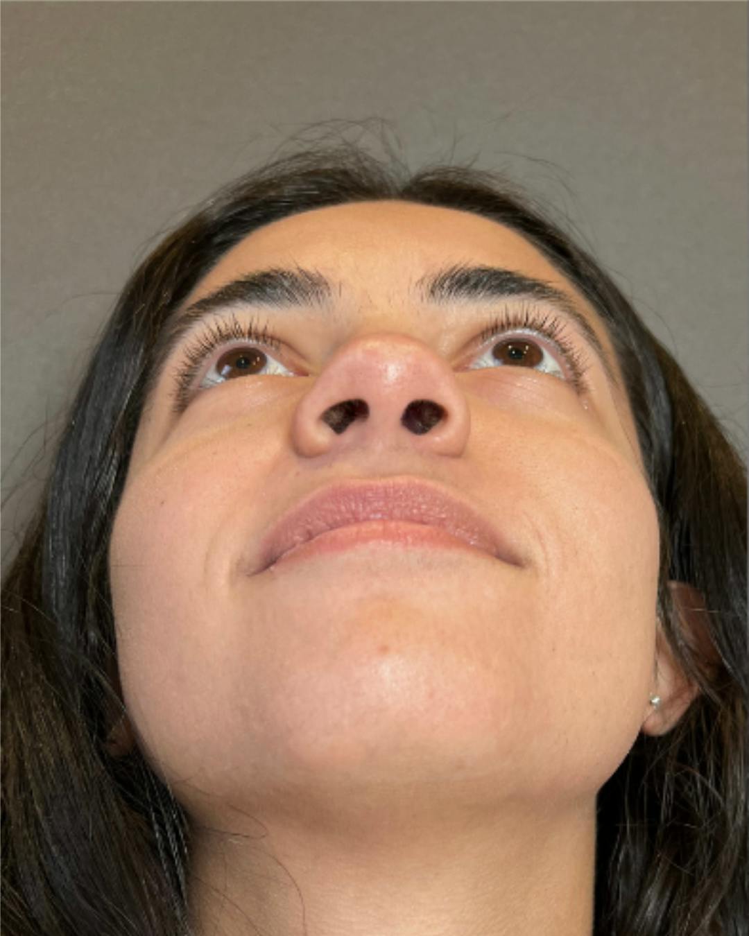 Rhinoplasty Before & After Gallery - Patient 171247 - Image 5