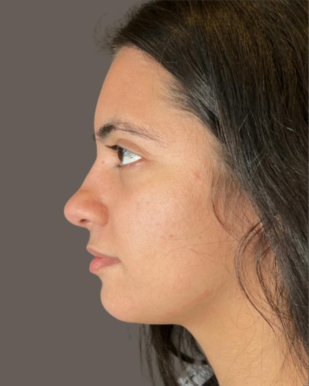 Rhinoplasty Before & After Gallery - Patient 171247 - Image 9