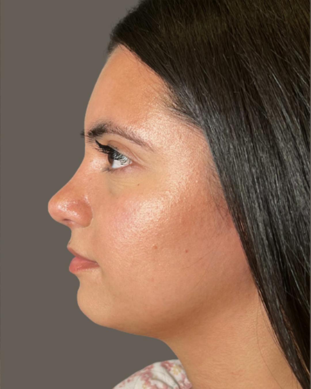 Rhinoplasty Before & After Gallery - Patient 171247 - Image 10