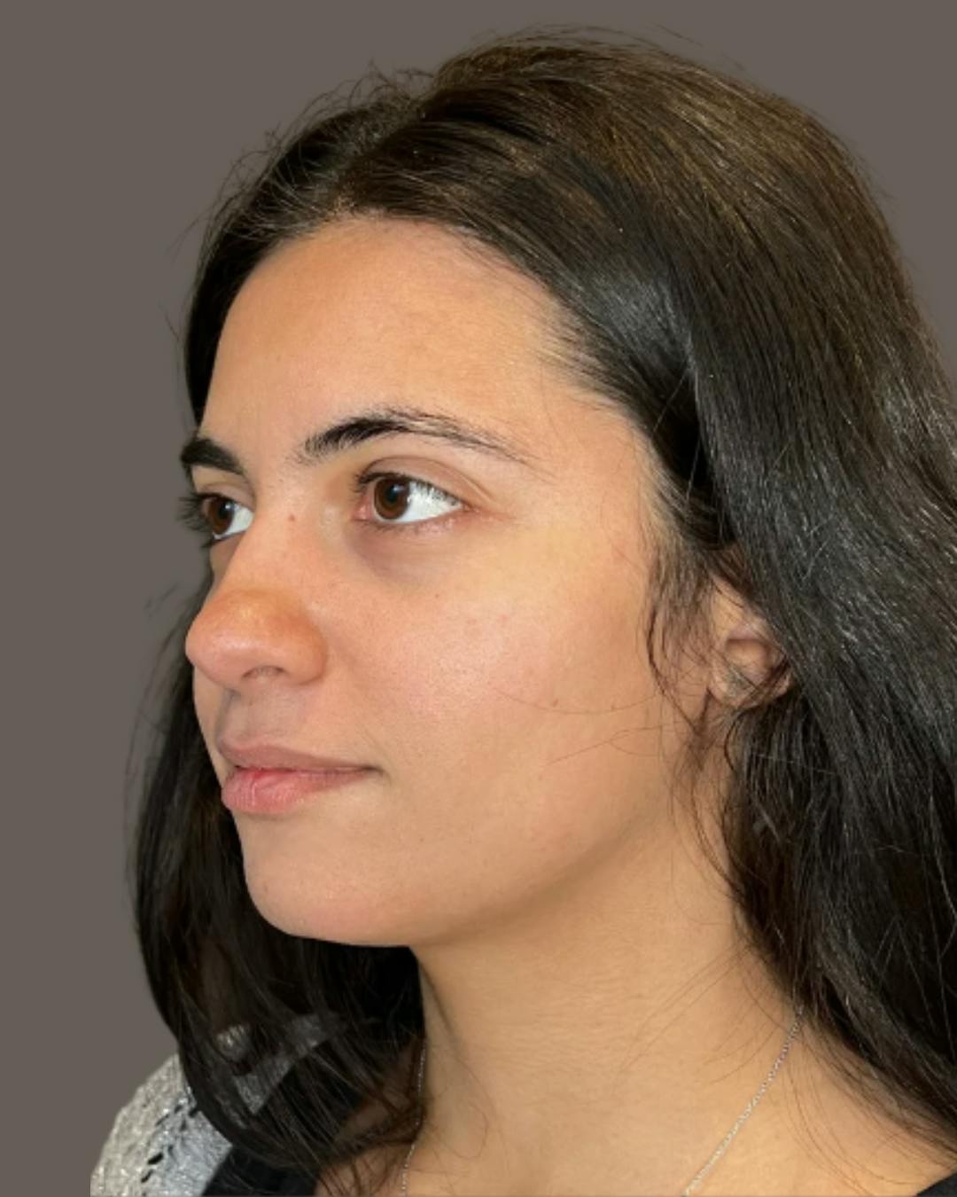 Rhinoplasty Before & After Gallery - Patient 171247 - Image 11