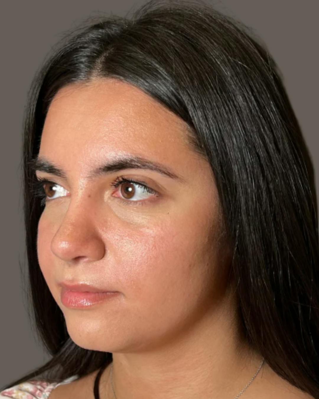 Rhinoplasty Before & After Gallery - Patient 171247 - Image 12