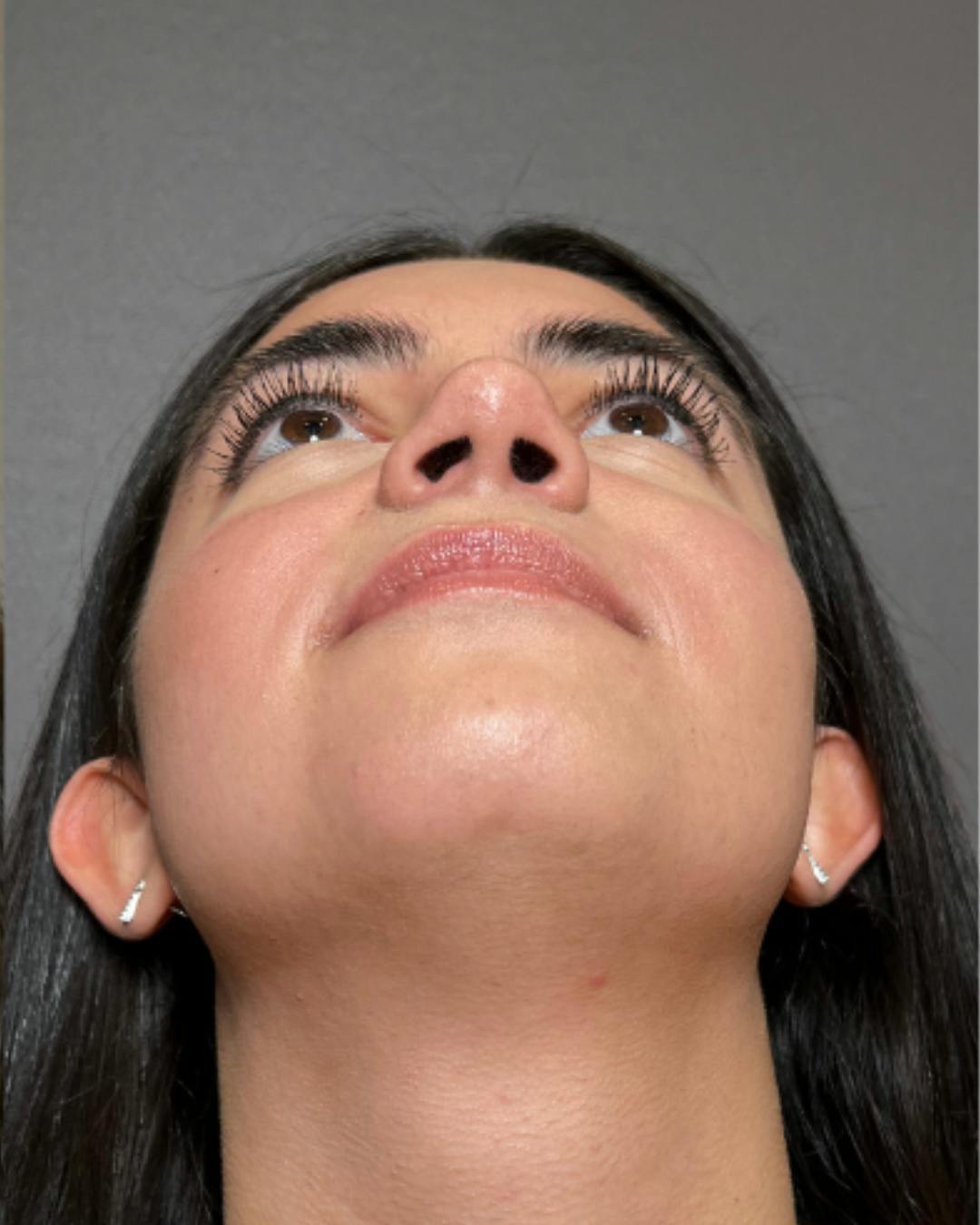 Rhinoplasty Before & After Gallery - Patient 171247 - Image 6