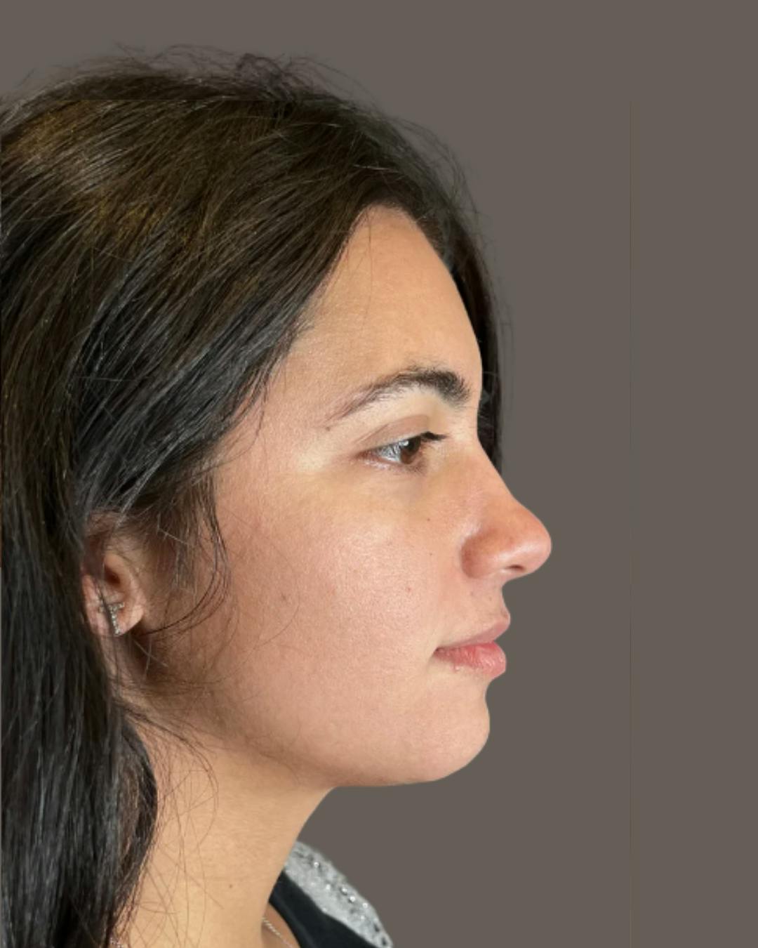 Rhinoplasty Before & After Gallery - Patient 171247 - Image 1