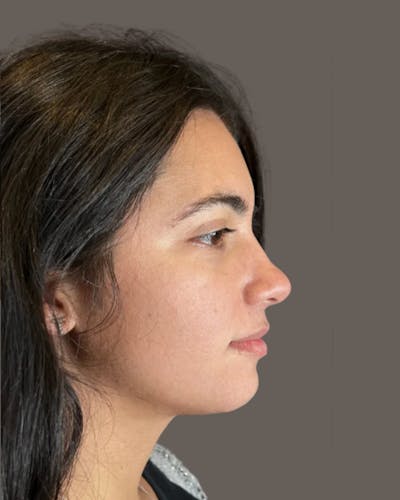 Rhinoplasty Before & After Gallery - Patient 171247 - Image 1