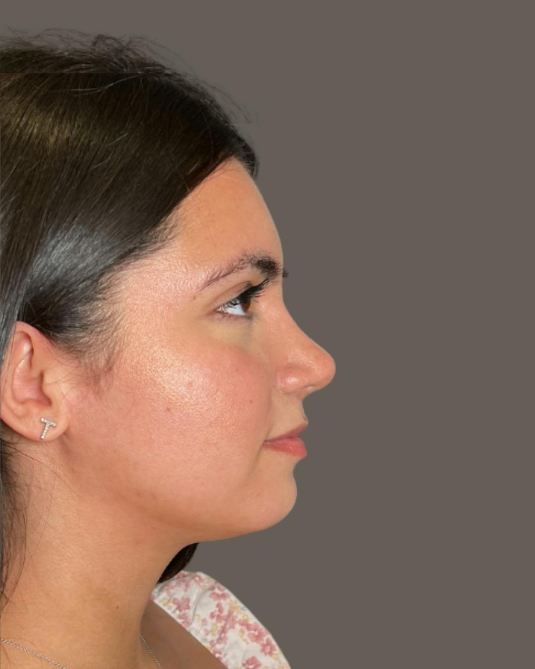 Rhinoplasty Before & After Gallery - Patient 171247 - Image 2