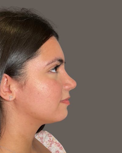 Rhinoplasty Before & After Gallery - Patient 171247 - Image 2