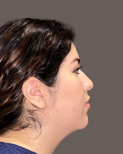 Rhinoplasty Before & After Gallery - Patient 273713 - Image 1