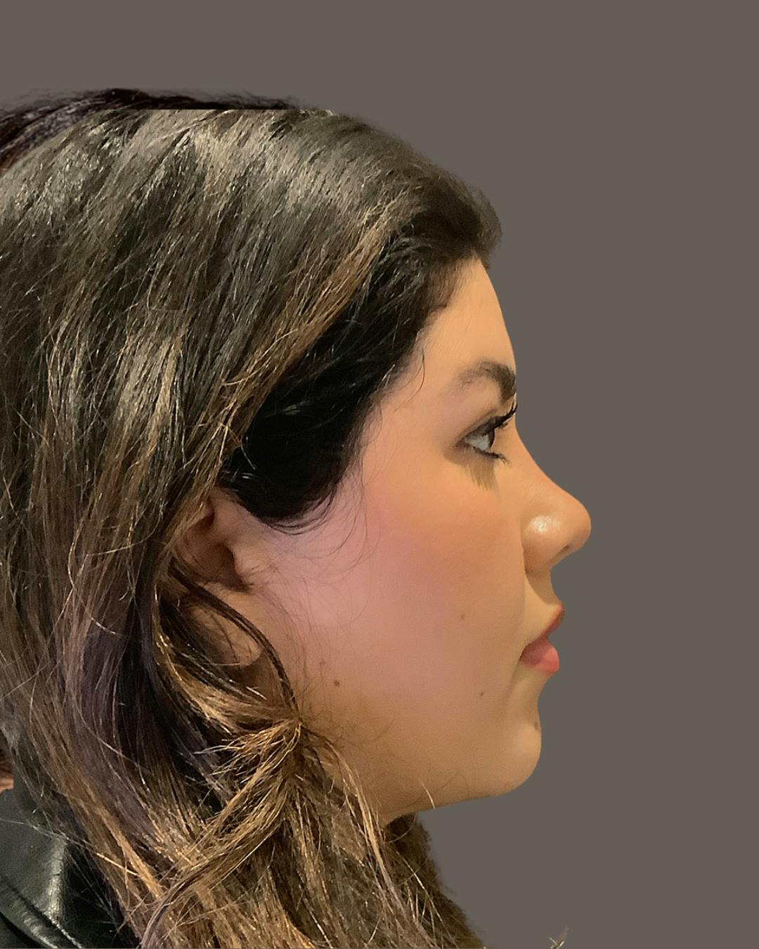 Rhinoplasty Before & After Gallery - Patient 273713 - Image 2