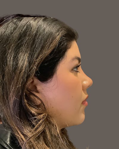 Rhinoplasty Before & After Gallery - Patient 273713 - Image 2