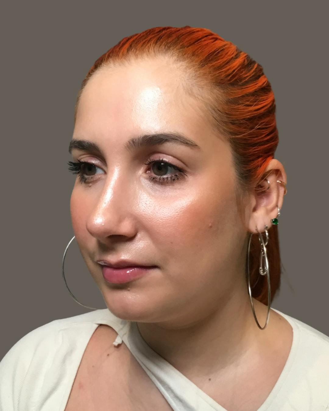 Rhinoplasty Before & After Gallery - Patient 143120 - Image 8