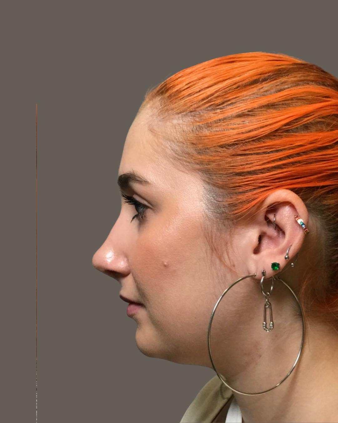 Rhinoplasty Before & After Gallery - Patient 143120 - Image 10
