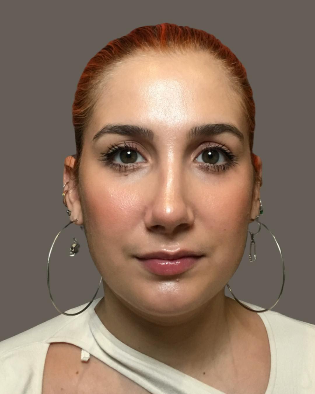 Rhinoplasty Before & After Gallery - Patient 143120 - Image 6