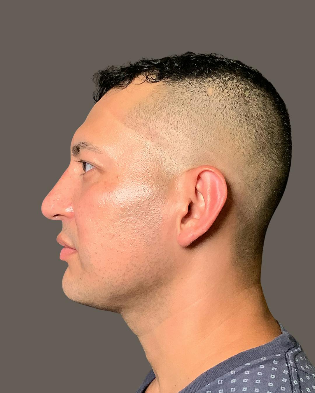 Rhinoplasty Before & After Gallery - Patient 748574 - Image 10